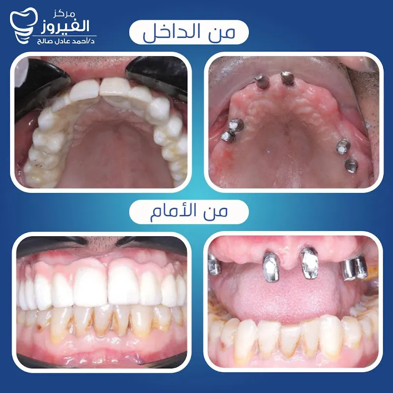 مركز الفيروز لطب الأسنان- فرع البحيرة -ايتاي البارود