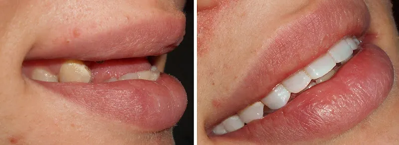 D Fixed Dental Implants