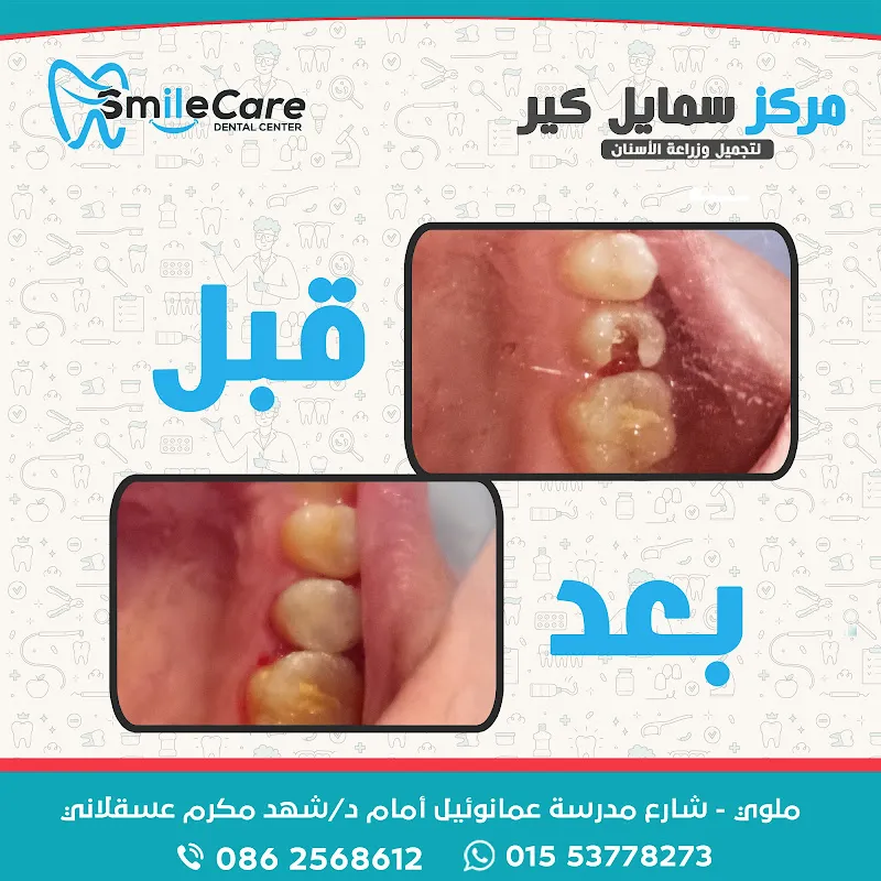مركز سمايل كير لتجميل وزراعة الأسنان