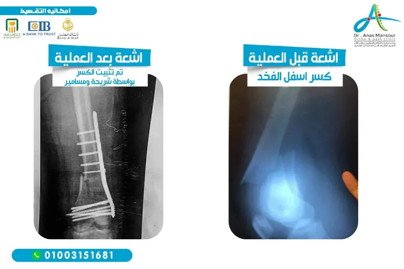 عيادة دكتور أنس منصور استشاري العظام فيصل
