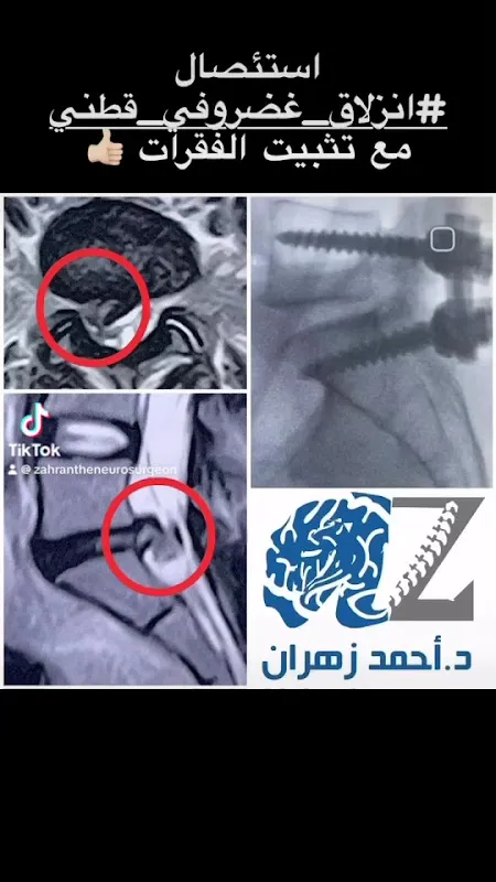 Dr. Ahmed Zahran Consultant Brain, Neurosurgery and Spine Dr. Ahmed Zahran (AZ NeuroSpine Clinic)